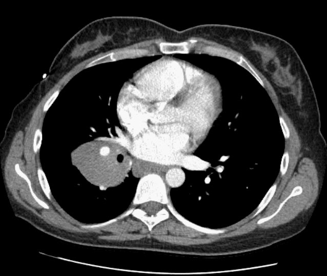 Right hilar mass | Image | Radiopaedia.org