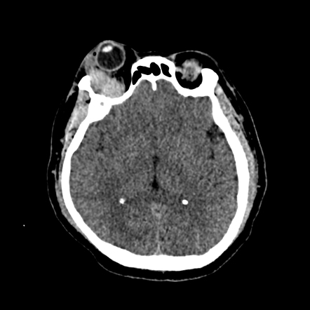 IgG4-related orbital disease mimicking orbital lymphoma | Radiology ...