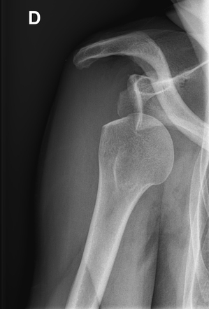 Hill-Sachs defect | Radiology Case | Radiopaedia.org