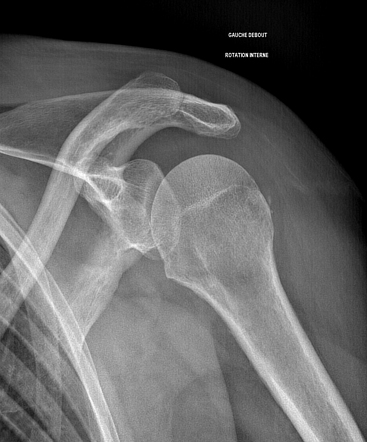 Infraspinatus tendon cleavage tear | Image | Radiopaedia.org