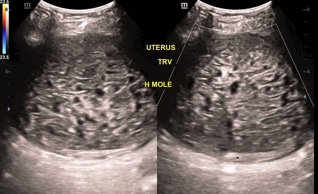 complete-hydatidiform-molar-pregnancy-image-radiopaedia