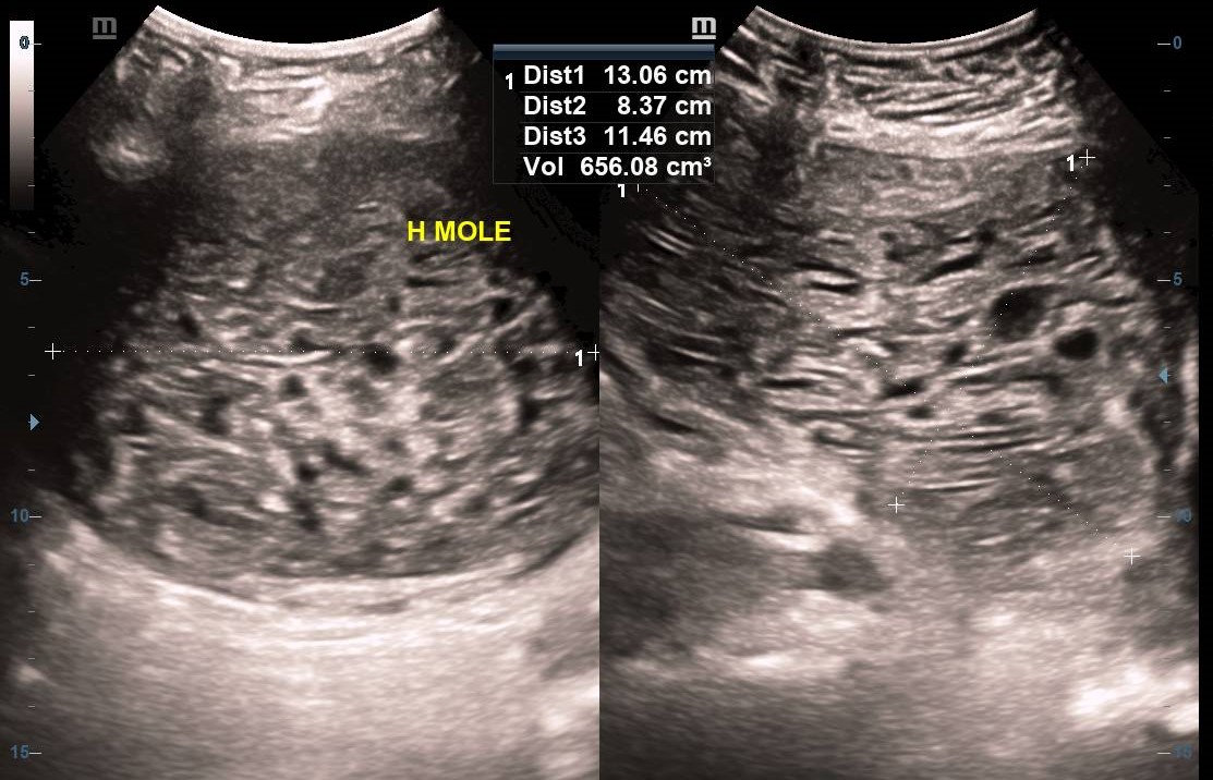 Hydatidiform Molar Pregnancy