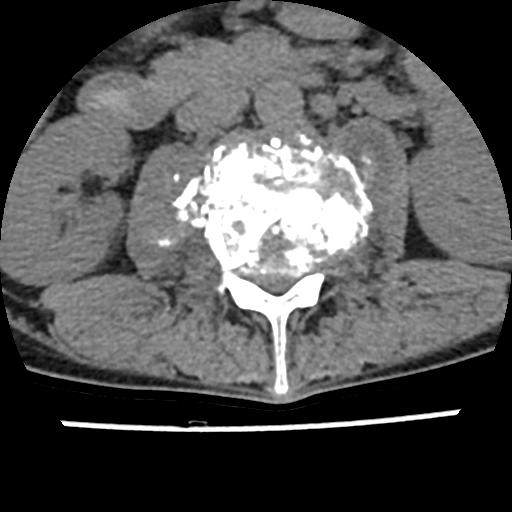 Tuberculous Spondylodiscitis | Image | Radiopaedia.org