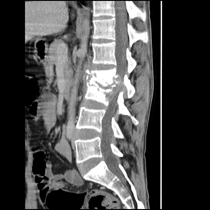 Tuberculous Spondylodiscitis | Image | Radiopaedia.org