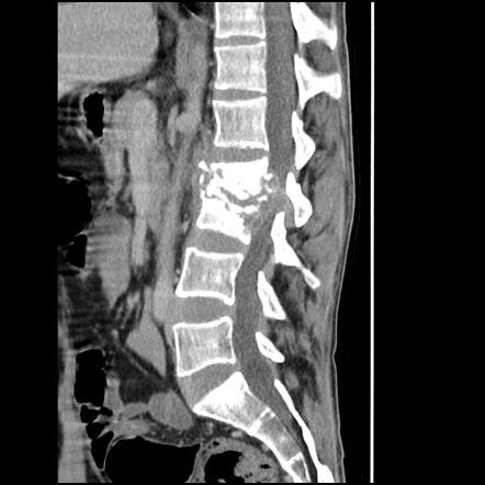 Tuberculous spondylodiscitis | Radiology Case | Radiopaedia.org