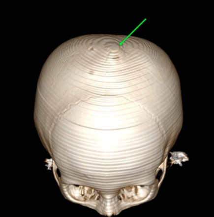 Arachnoid granulation | Radiology Case | Radiopaedia.org