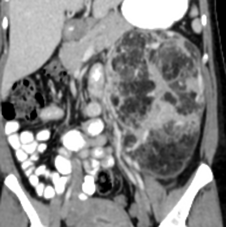 Giant renal angiomyolipoma | Radiology Case | Radiopaedia.org