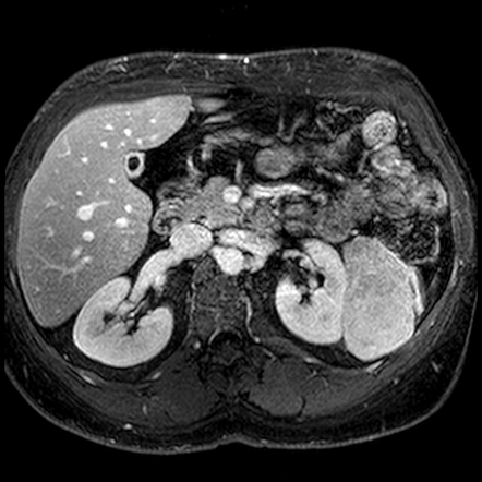 Lipid-poor renal angiomyolipoma | Image | Radiopaedia.org