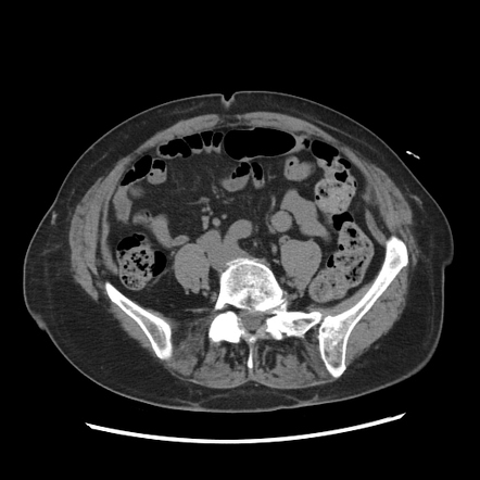 Renal arteriovenous fistula with associated renal aneurysm | Image ...