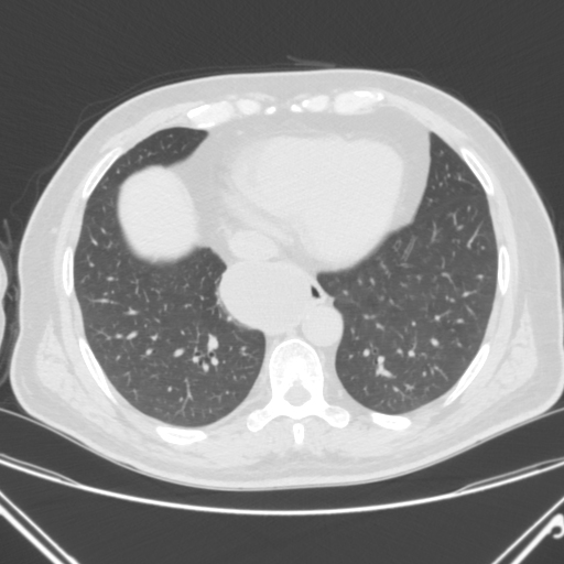 Esophageal duplication cyst | Image | Radiopaedia.org