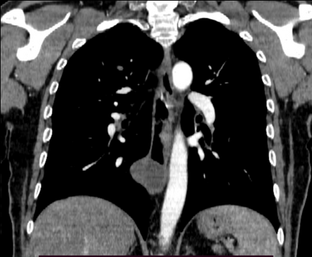 Esophageal duplication cyst | Image | Radiopaedia.org