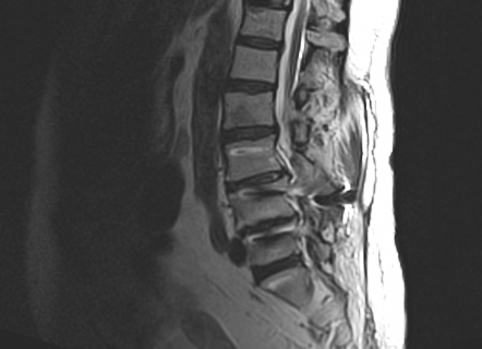 Synovial cyst from degenerative facet joint disease | Radiology Case ...