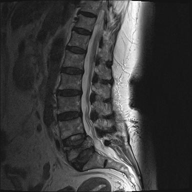 Acute osteoporotic compression fracture - L5 | Image | Radiopaedia.org