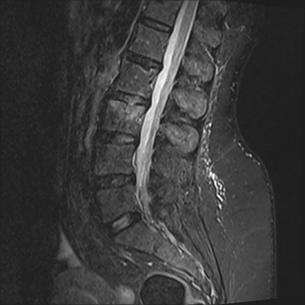 Acute Schmorl node | Image | Radiopaedia.org