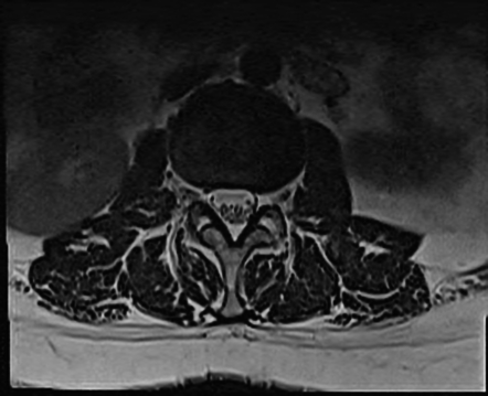 Acute Schmorl node | Image | Radiopaedia.org