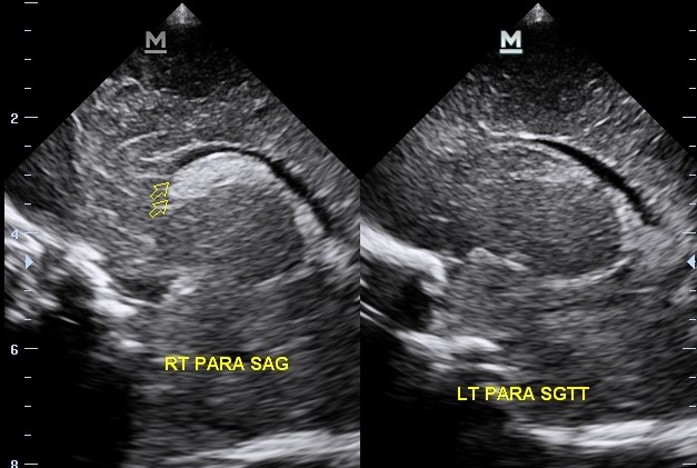 Grade 1 Germinal Matrix Hemorrhage Image