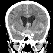 Subarachnoid hemorrhage  Radiology Reference Article