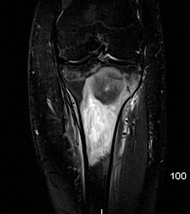 Osteosarcoma | Image | Radiopaedia.org