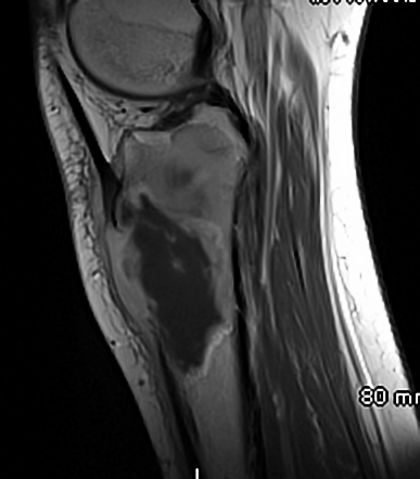 Osteosarcoma | Image | Radiopaedia.org