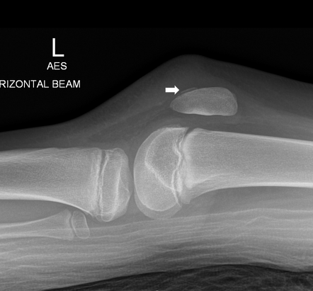 Patella sleeve avulsion fracture | Image | Radiopaedia.org