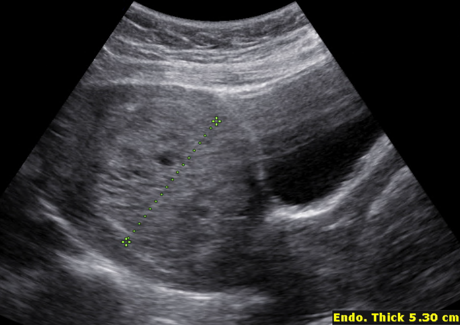 Complete Hydatidiform Mole 