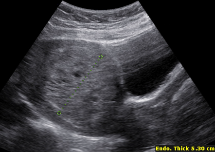 Complete hydatidiform mole | Image | Radiopaedia.org