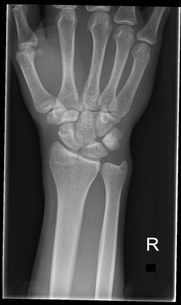 Radial styloid fracture | Radiology Case | Radiopaedia.org