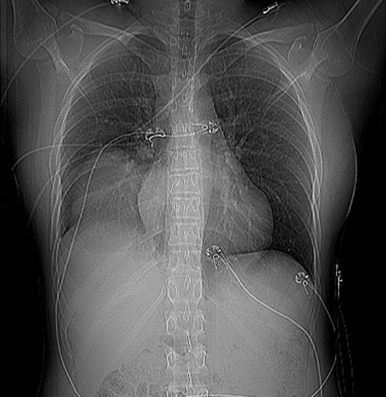 Pulmonary blastoma | Image | Radiopaedia.org