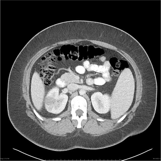 Radiology Quiz Radiopaedia Orgviewing Playlist Nieren Radiopaedia Org