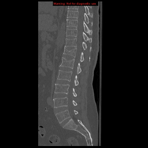 Vertebral compression fractures | Image | Radiopaedia.org