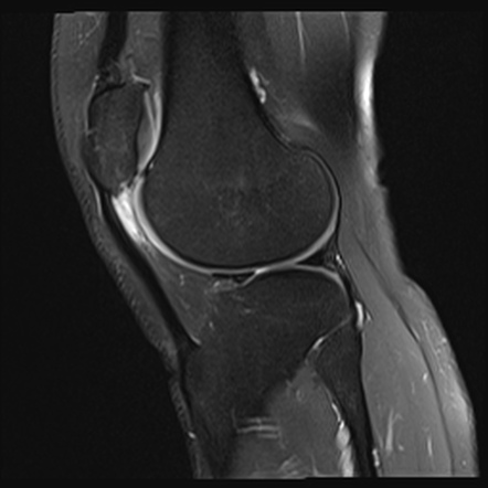 Patellar Tendon-lateral Femoral Condyle Friction Syndrome 