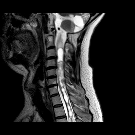 Von Hippel-lindau Disease 