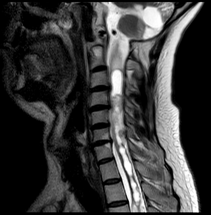 Von Hippel-Lindau disease | Radiology Reference Article | Radiopaedia.org