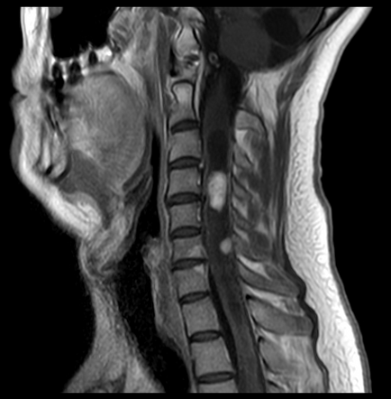 Von Hippel-Lindau disease | Image | Radiopaedia.org