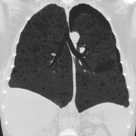 Lymphangioleiomyomatosis | Image | Radiopaedia.org