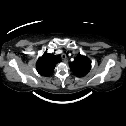 Relapsing polychondritis | Radiology Reference Article | Radiopaedia.org