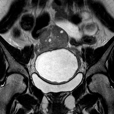 Ovarian torsion | Image | Radiopaedia.org