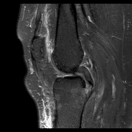 Posterior Cruciate Ligament Avulsion Fracture | Radiology Case ...