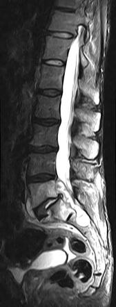 Tuberculous Spondylodiscitis | Radiology Case | Radiopaedia.org