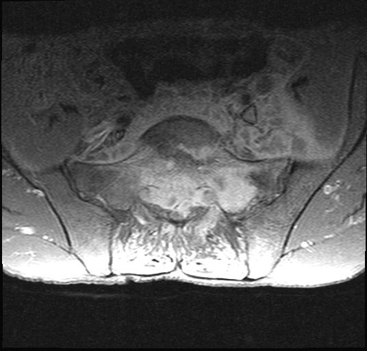 Tuberculous Spondylodiscitis | Image | Radiopaedia.org