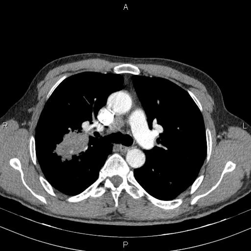 Squamous cell carcinoma of the lung | Image | Radiopaedia.org