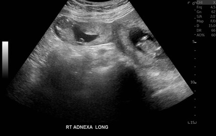 Heterotopic Pregnancy | Radiology Case | Radiopaedia.org