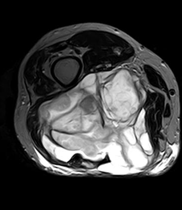 Myxoid liposarcoma | Image | Radiopaedia.org