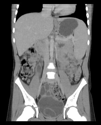 Duplex collecting system with ureterocele | Image | Radiopaedia.org