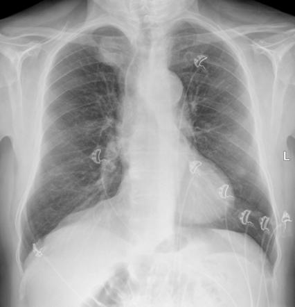 Right upper lobe opacity | Image | Radiopaedia.org