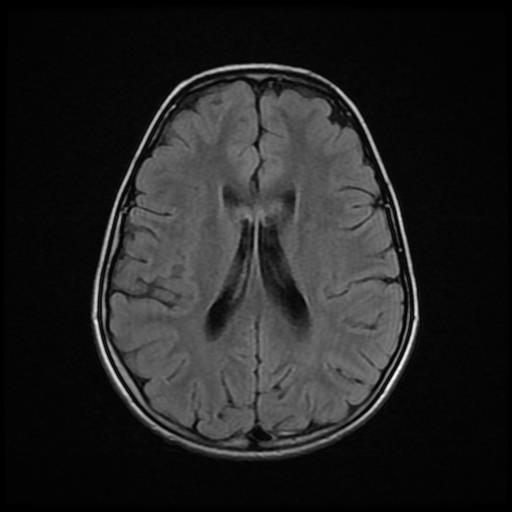 Area postrema syndrome | Image | Radiopaedia.org