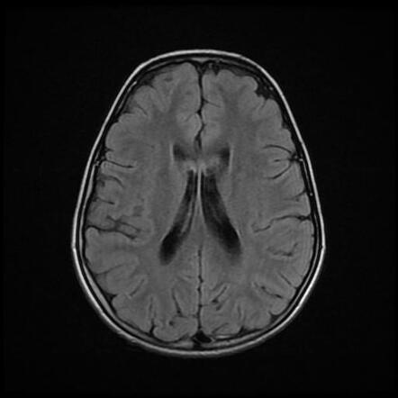 Area postrema syndrome | Image | Radiopaedia.org