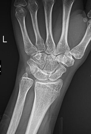 Lunotriquetral coaliation | Radiology Case | Radiopaedia.org