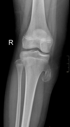 Osteochondroma | Radiology Case | Radiopaedia.org