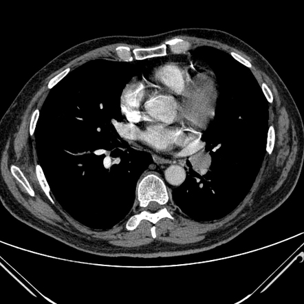 Carcinoid tumor of the lung | Radiology Case | Radiopaedia.org